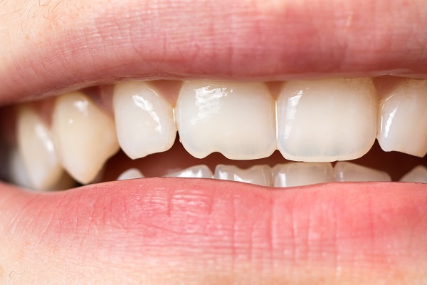 Fix A Chipped Tooth With A Dental Veneer
